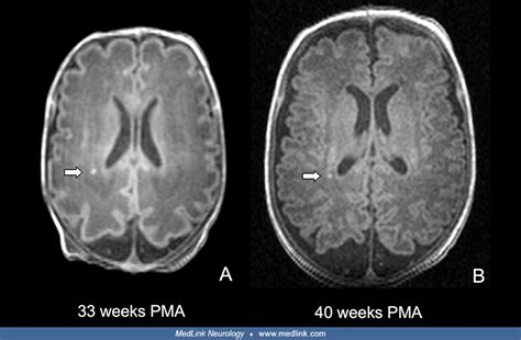 Cerebral Palsy Brain Scan Comparison