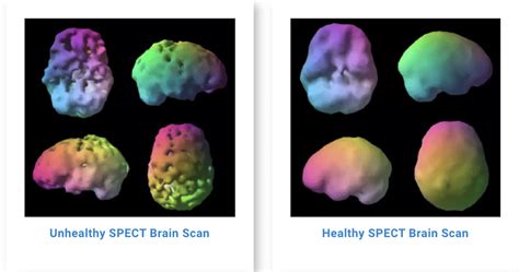 What are the Different Types of Brain Scans?