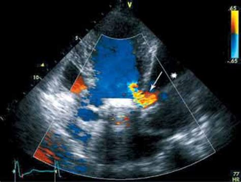 Two Dimensional Color Doppler Echocardiography Showing A Turbulent