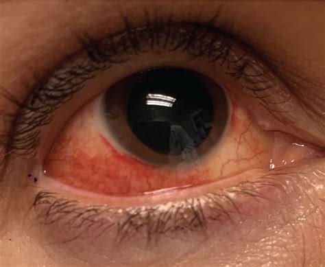 Episcleritis Vs Scleritis