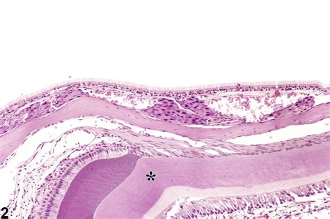 Nose Epithelium Fibrosis Nonneoplastic Lesion Atlas