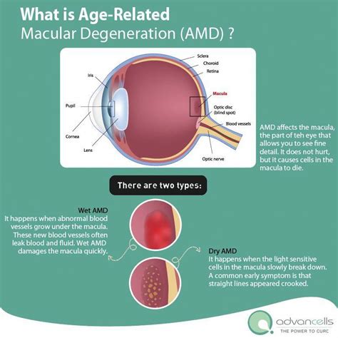 Diy Stem Cell Therapy For Eyesight A Comprehensive Guide Martlabpro