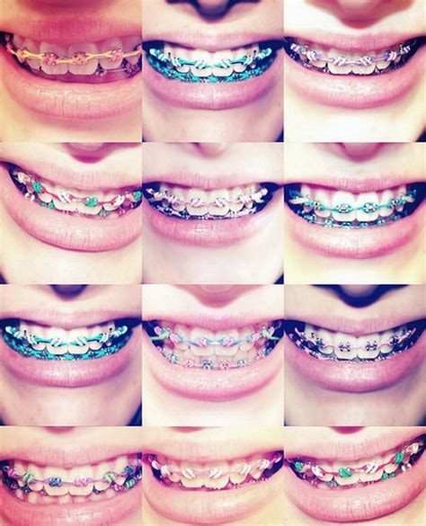 Best Braces Band Colors – Warehouse of Ideas