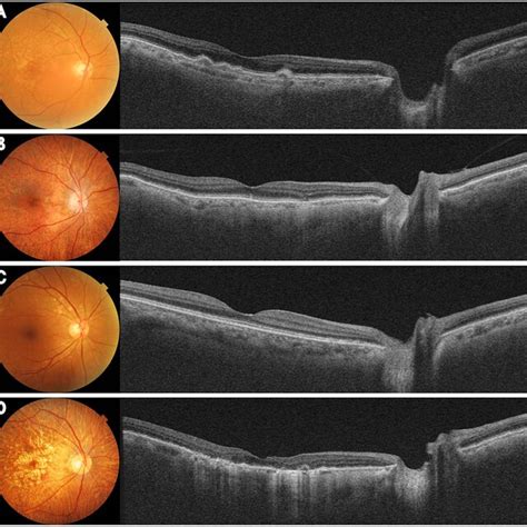 Color Fundus Photograph And Swept Source Optical Coherence Tomography