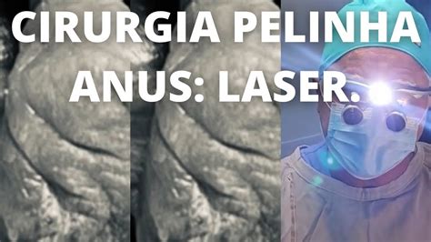 Fazendo Cirurgia P Pelinha Anus C Laser Sob Anestesia Local Sem