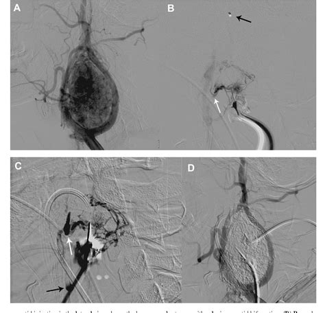 Figure 1 From Preoperative Embolization Of Carotid Body Tumor By Direct