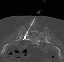 Sacroplasty - Imaging Glossary - Patients - UR Medicine Imaging ...