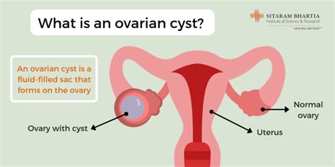 Ovarian Follicular Cyst