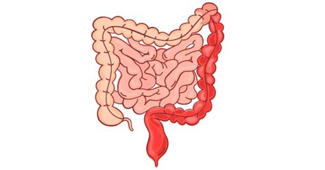 What Are The Stages Signs And Symptoms Of Ulcerative Colitis Dr