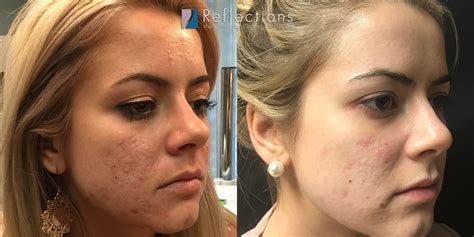 Acne Dark Spots Before And After