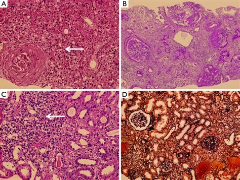 The hallmarks of AIN. AIN with prominent interstitial inflammation ...