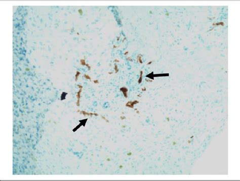 Figure From A Novel Case Of Biliary Atresia In A Premature Neonate