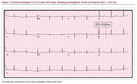 Electrocardiography In Athletes How To Identify High Risk Subjects