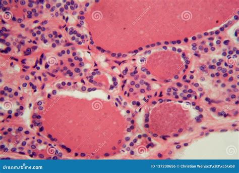 Cells Of A Human Thyroid Gland With Swelling Under A Microscope Stock ...