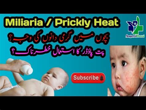 Miliaria Prickly Heat Cause Symptoms Treatment Urdu Hindi Public