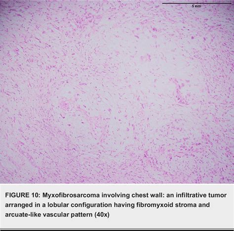 Figure 10 From The Expression Of Mucin 4 Muc4 In Sarcomas Apart From Sclerosing Epithelioid