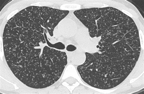 Case Same Sized Small Lung Nodules