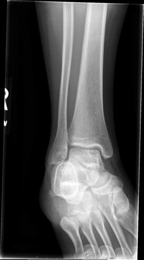 Osteochondritis Dissecans Image