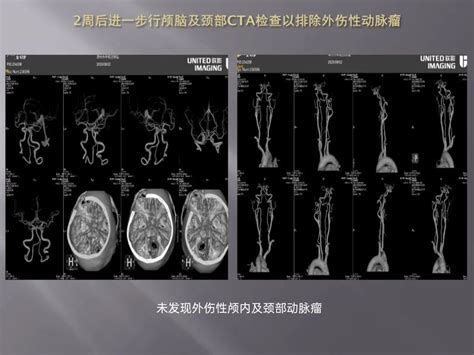 监测有道丨重型开放性颅脑损伤内异物个例报告——颅脑创伤 神经重症周刊（第204期） 脑医汇 神外资讯 神介资讯