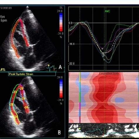 Speckle Tracking Echocardiography Transthoracic Four Chamber Apical