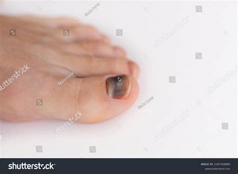 Subungual Hematoma Present Under Toenail Hallux Stock Photo 2187358889