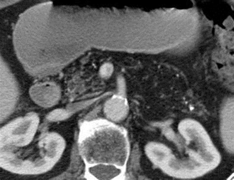 Anomalies Anatomic Variants And Sources Of Diagnostic Pitfalls In