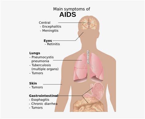 Symptoms Of Aids - Know If You Have Aids - Free Transparent PNG ...