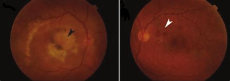 A Fundus Photograph Of The Right Eye Shows A Large Disciform Scar And Download Scientific