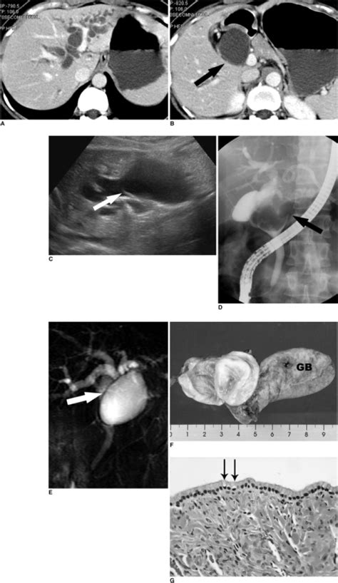 Unilocular Extrahepatic Biliary Cystadenoma In A 42 Yea Open I