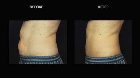 Coolsculpting Beforeafter Photos Dermmedica