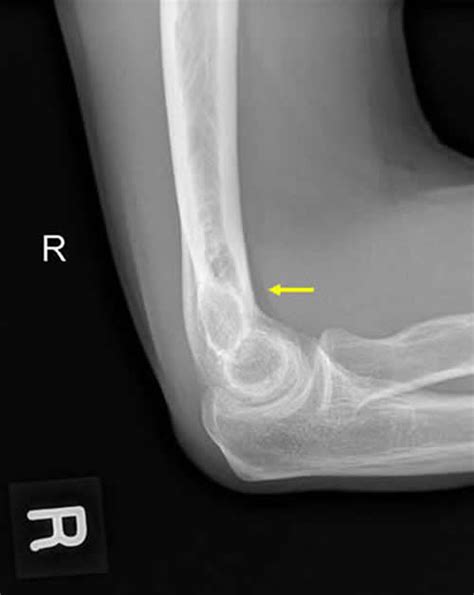 Imaging Fat Pads Rcemlearning India