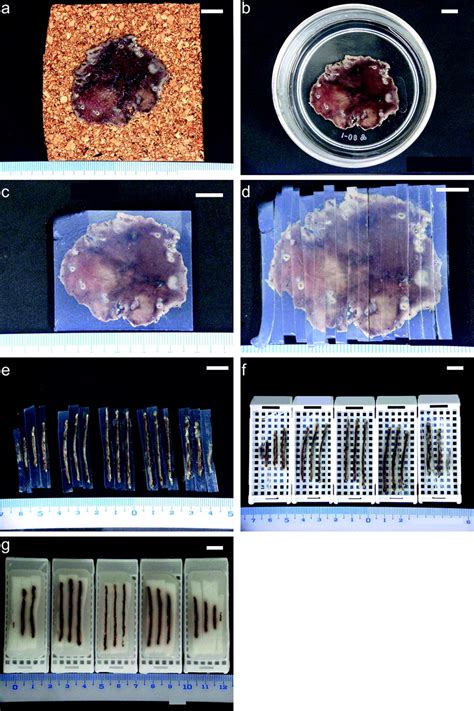 New Double Embedding Technique For Specimens Of Endoscopic Submucosal