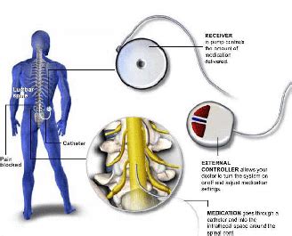 Back Pain Releif With Implantable Devices State Of The Art