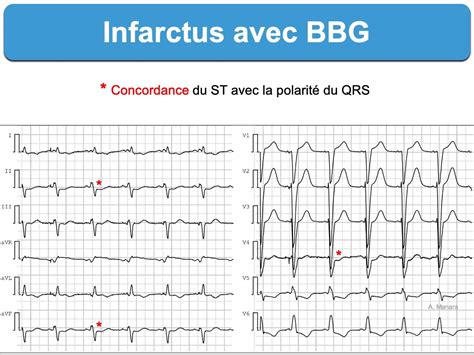 Infarctus C Bbg E Cardiogram