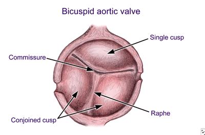 Bicuspid Aortic Valve - Symptoms, Diagnosis, Treatment & Surgery