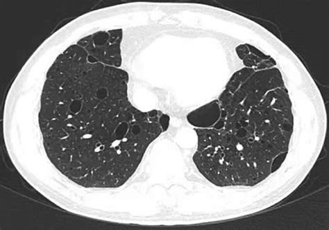 Chest High Resolution Computed Tomography Scan Showing Multiple