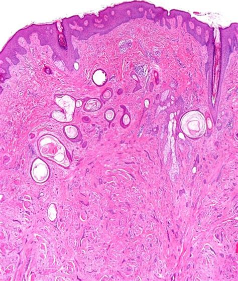 An Infiltrating Dermal Tumor With Slightly Acanthotic Epidermis