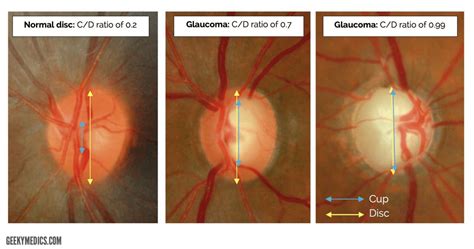 Glaucoma Treatment | Best glaucoma doctor in Bangalore | My Vision Eye ...