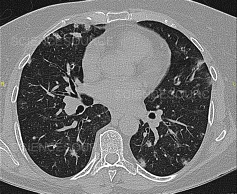 Bronchiectasis On Ct Scan