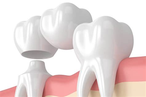 Dental Bridge Vs Implant Which Is Better Rio Grande Oral Surgery