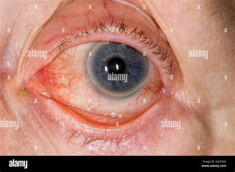 Chronic Blepharitis Of The Eye Of An Elderly Patient Showing An