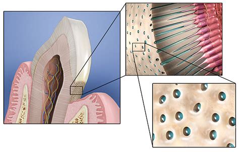 Dentin Hypersensitivity | September 2011 | Inside Dentistry