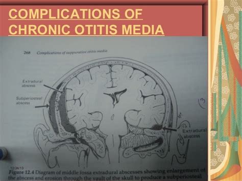 Complications of chronic otitis media