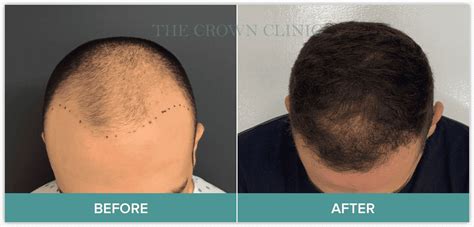 Fue Hair Transplantation Sydney The Crown Clinic