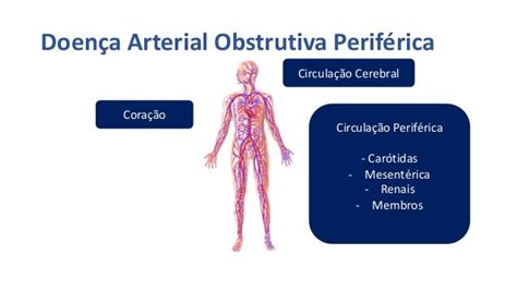 Doença Arterial Obstrutiva Periférica