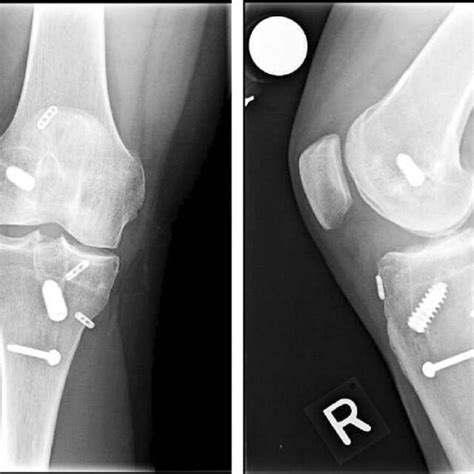 Knee X Rays With Ap View Left And Lateral View Right Taken At 17 Download Scientific