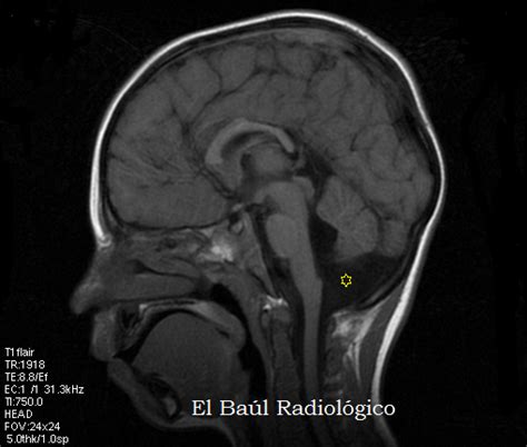 El Baúl Radiológico DISGENESIA DEL CUERPO CALLOSO HALLAZGOS EN TC e