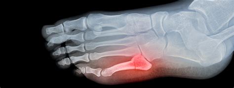 What You Should Know About A Broken Pinky Toe Orthopedic Sports