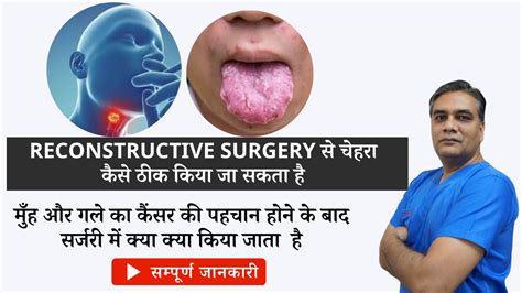 Muh Aur Gale Ke Cancer Ka Ilaj Kya Hai Oral Cancer