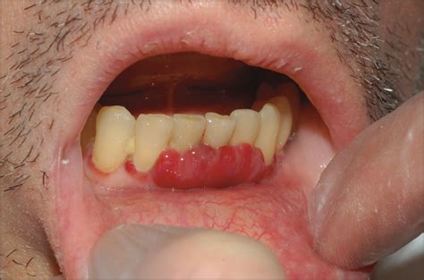 Gingival Hypertrophy And Anemia—quiz Case Hematology Jama